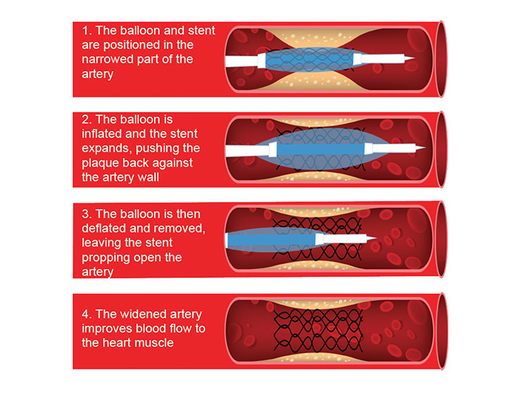 Angioplasty Stents Heart Foundation