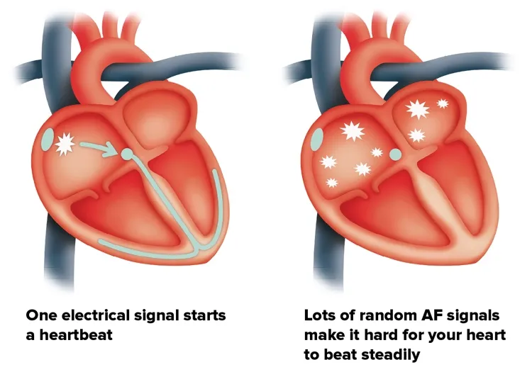 A healthy heart and a heart affected by atrial fibrillation side by side. One electrical signal triggers a regular heartbeat, while random signals causes an irregular beat.