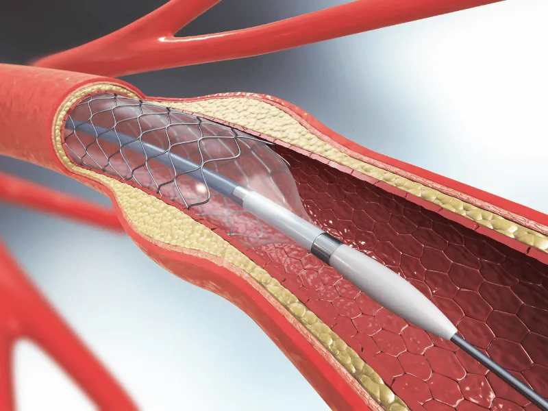 3D illustration of coronary angioplasty showing a balloon catheter expanding a metal stent inside a narrowed artery with plaque buildup, restoring blood flow to the heart.