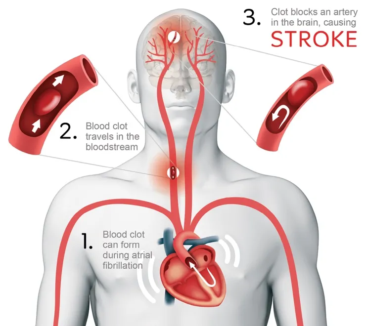 A step-by-step example showing how a blood clot can form in the heart and travel to the brain.