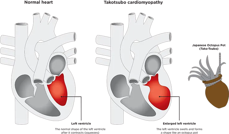 Two hearts. One with a left ventricle that is the normal shape after it contracts. The other shows an enlarged left ventricle 