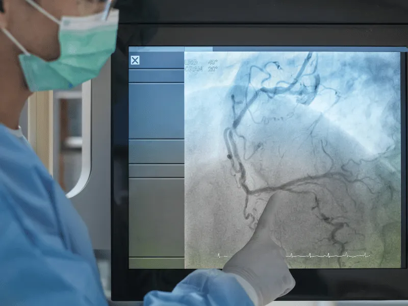 Cardiologist reviewing a coronary angiogram image on a monitor, pointing to narrowed heart arteries during an invasive coronary angiography procedure.