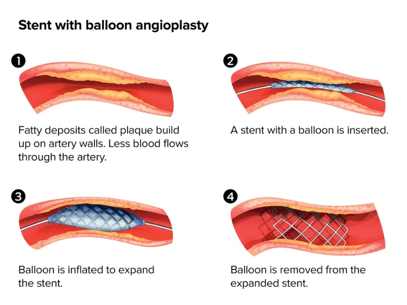Illustration showing how coronary stent with balloon angioplasty works in four steps, from plaque buildup in a narrowed artery to balloon inflation and removal, leaving an expanded stent to restore blood flow.