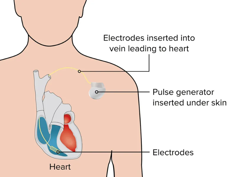 Diagram of transvenous implantable cardioverter defibrillator (ICD) with pulse generator under the skin and electrodes threaded through a vein into the heart