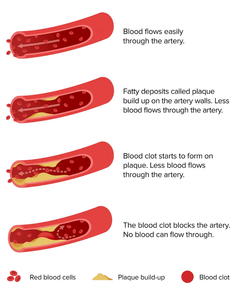 Progression of artery plaque build up and blood clots showing how high cholesterol leads to narrowed arteries reduced blood flow and risk of heart attack or stroke