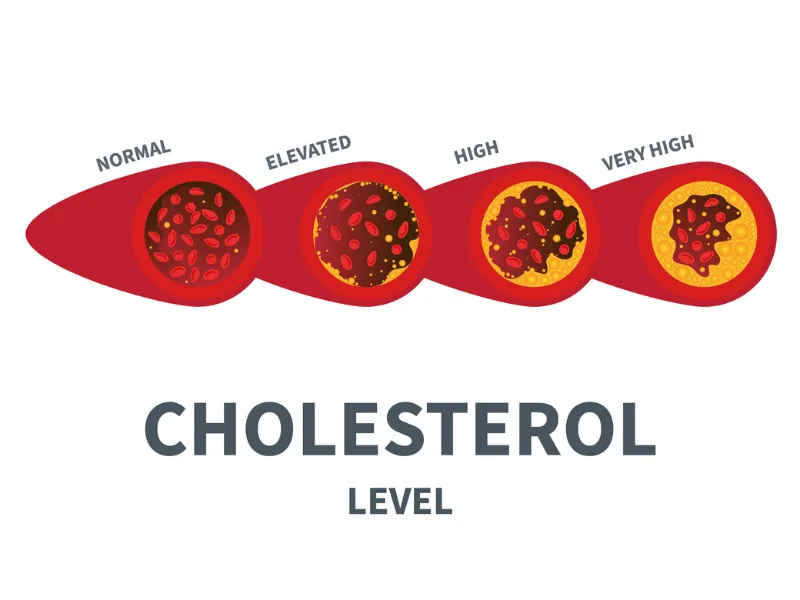 Illustration of cholesterol levels in an artery showing normal elevated high and very high cholesterol with increasing plaque build up.