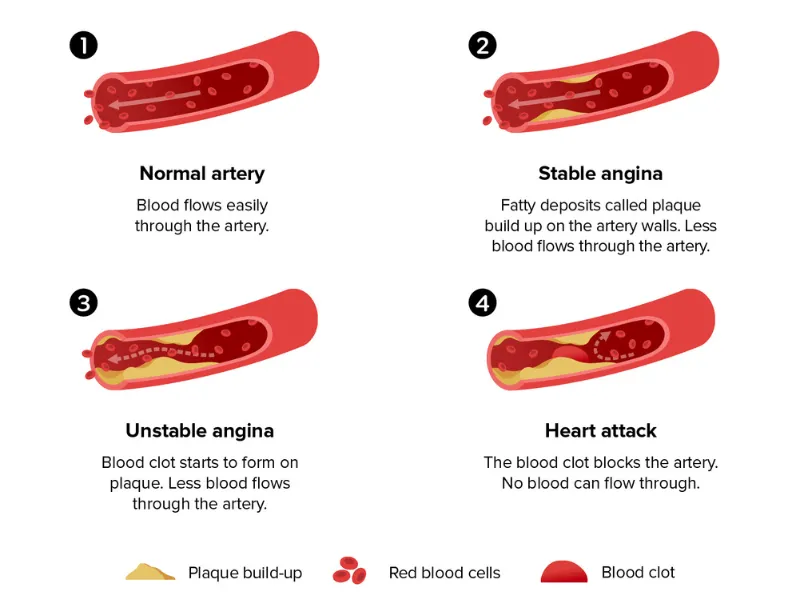 Infographic showing the 4 stages of Agina