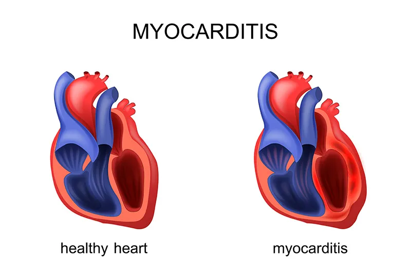 A diagram illustrating a healthy heart and a heart with myocarditis