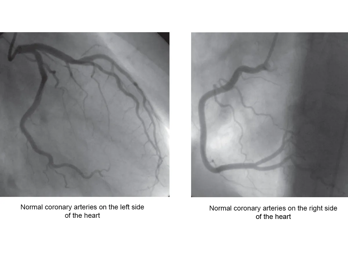 healthy heart arteries look wide on an angiogram