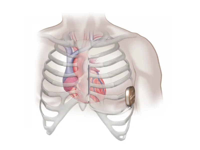 Medical illustration of subcutaneous implantable cardioverter defibrillator (S-ICD) showing device and lead positioned outside the ribcage next to the heart.
