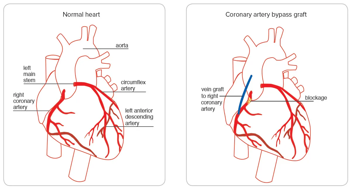 image of a normal heart next to a heart that's had a coronary artery bypass graft. The heart that's had the coronary artery bypass graft shows a blockage and new vein.